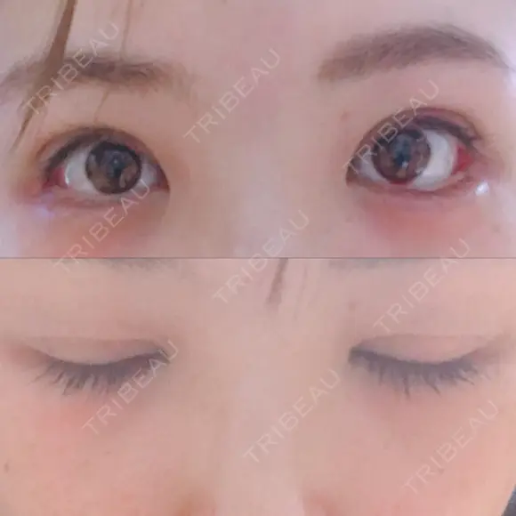 二重切開 / 眼瞼下垂（切開） / 目尻切開 ジュエリー美容外科 DAY 10 メイン用