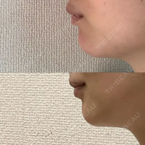 ボトックス（あご） PICO BEAUTY CLINIC DAY 8 メイン用