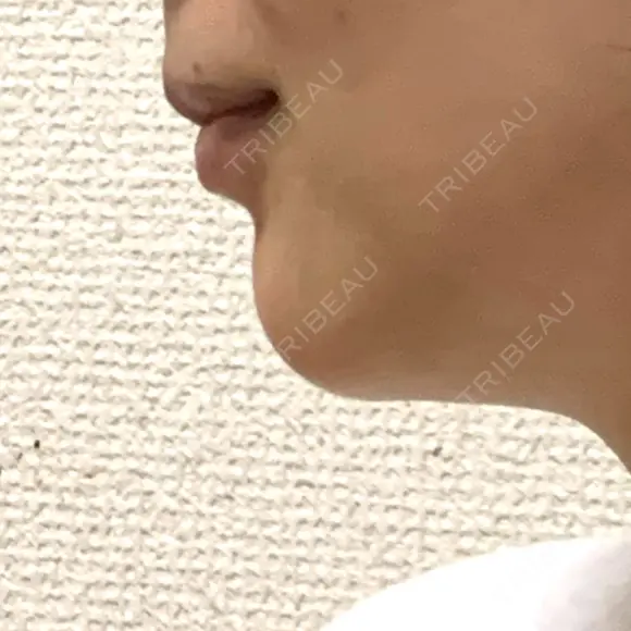 ボトックス（あご） PICO BEAUTY CLINIC AFTER メイン用