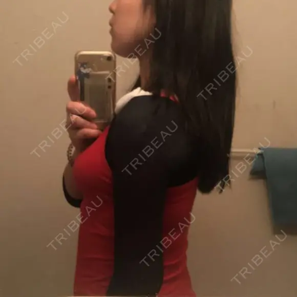 脂肪吸引（二の腕） 湘南美容クリニック 八王子院 AFTER メイン用