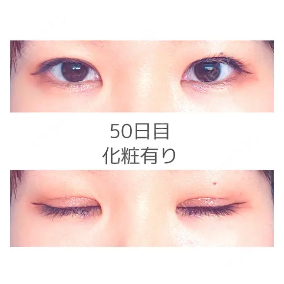 二重切開 TCB東京中央美容外科 宇都宮院 DAY 50 メイン用