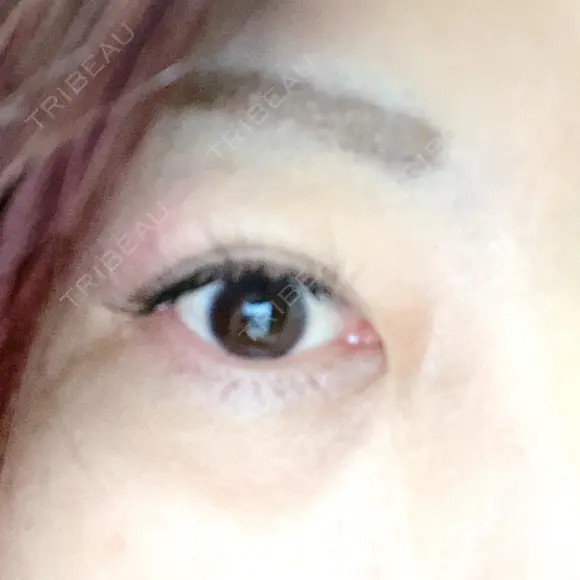 下まぶたの脂肪取り 湘南美容クリニック 千葉センシティ院 DAY 15 メイン用