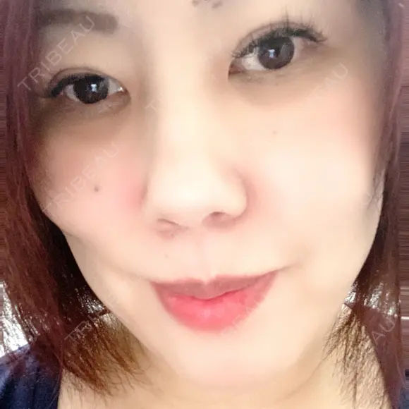 下まぶたの脂肪取り 湘南美容クリニック 千葉センシティ院 DAY 15 メイン用