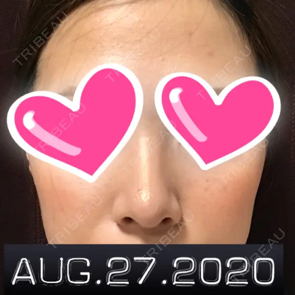 鼻尖形成（切開） / 小鼻縮小（切開） / 軟骨移植 湘南美容クリニック 船橋院 DAY 18 メイン用