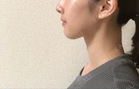脂肪溶解注射（顔） 銀座フェイスクリニック（小顔整形・輪郭整形專門） DAY 10 メイン用