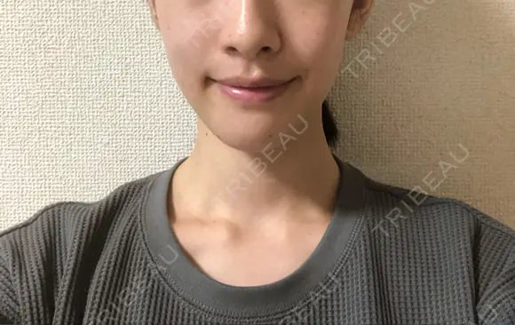 脂肪溶解注射（顔） 銀座フェイスクリニック（小顔整形・輪郭整形專門） DAY 10 メイン用
