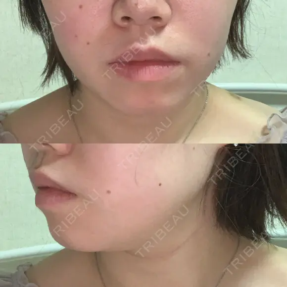 ボトックス（エラ・小顔） 湘南美容クリニック 川崎院 DAY 5 メイン用