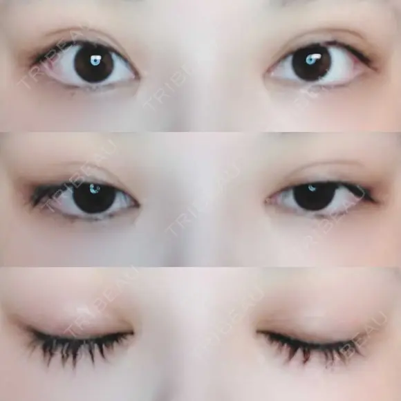 二重切開 / 目頭切開 / 上まぶたたるみ取り 湘南美容クリニック 金沢院 DAY 174 メイン用