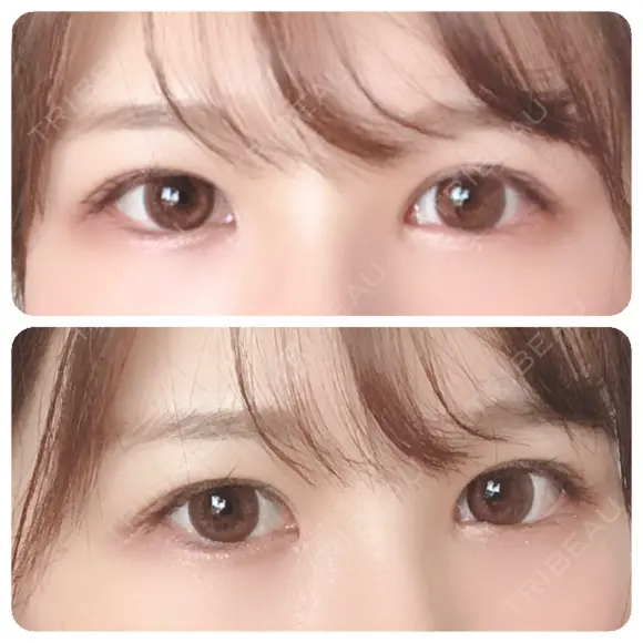 二重切開 / 上まぶたの脂肪取り 太田西ノ内病院 AFTER メイン用