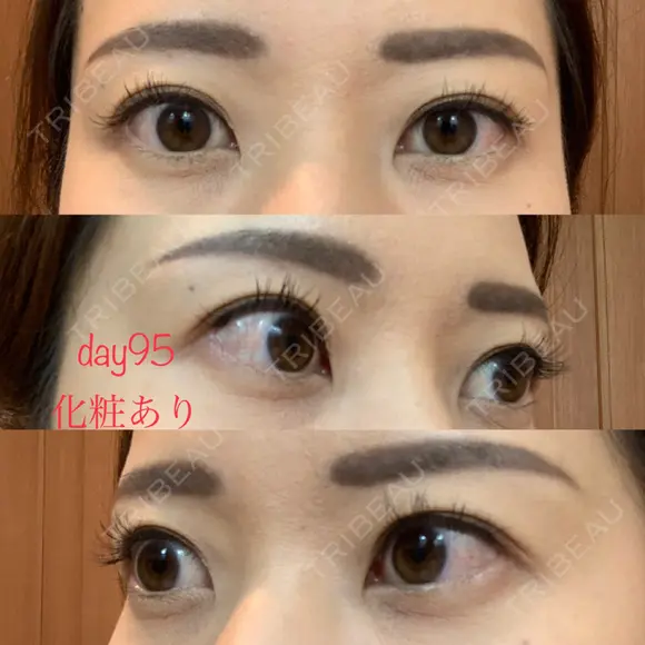 眉下切開 湘南美容クリニック 秋葉原院 DAY 95 メイン用