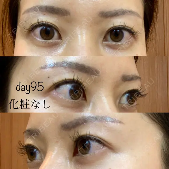 眉下切開 湘南美容クリニック 秋葉原院 DAY 95 メイン用