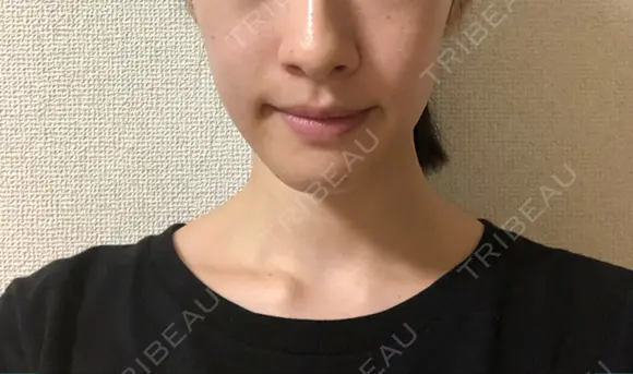 脂肪溶解注射（顔） 銀座フェイスクリニック（小顔整形・輪郭整形專門） DAY 14 メイン用