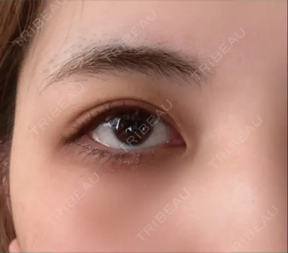 二重埋没 湘南美容クリニック 藤沢院 DAY 22 メイン用