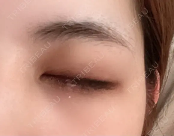 二重埋没 湘南美容クリニック 藤沢院 DAY 22 メイン用