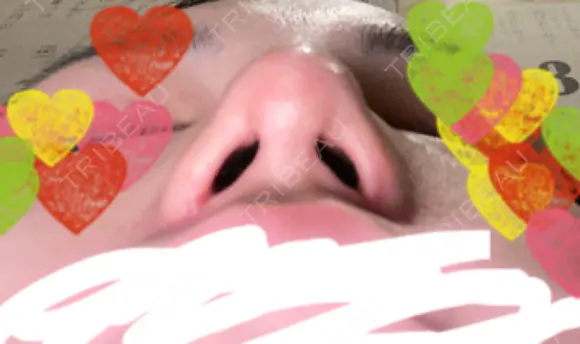 隆鼻術 / 鼻尖形成（切開） / 小鼻縮小（切開） / 軟骨移植 / 鼻翼基部形成（貴族手術） グローバルビューティークリニック 大阪院 DAY 40 メイン用