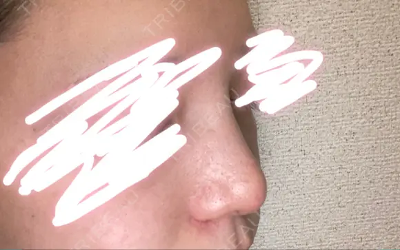 隆鼻術 / 鼻尖形成（切開） / 小鼻縮小（切開） / 軟骨移植 / 鼻翼基部形成（貴族手術） グローバルビューティークリニック 大阪院 DAY 40 メイン用