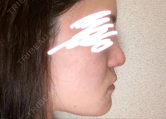 隆鼻術 / 鼻尖形成（切開） / 小鼻縮小（切開） / 軟骨移植 / 鼻翼基部形成（貴族手術） グローバルビューティークリニック 大阪院 DAY 40 メイン用