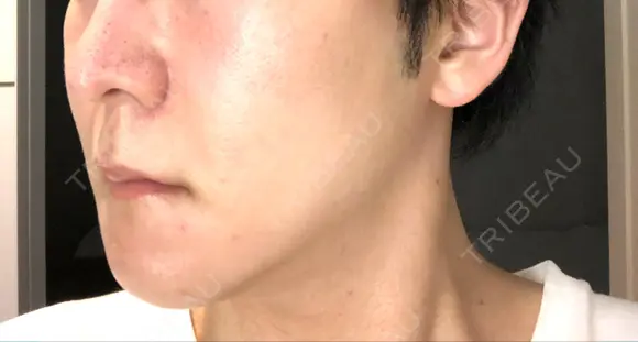 骨切り（あご） / 骨削り（エラ） 加藤クリニック 麻布東京院 DAY 30 メイン用