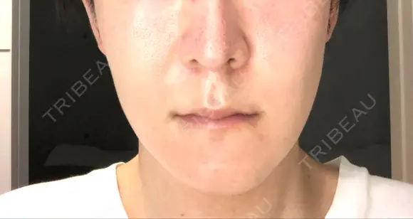 骨切り（あご） / 骨削り（エラ） 加藤クリニック 麻布東京院 DAY 30 メイン用