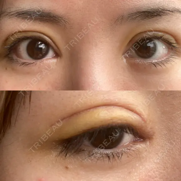 二重切開 / 眼瞼下垂（切開） / 目元修正 シエルクリニック DAY 7 メイン用
