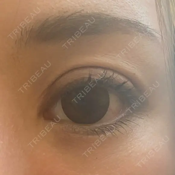 二重切開 / 眼瞼下垂（切開） / 目元修正 シエルクリニック DAY 9 メイン用