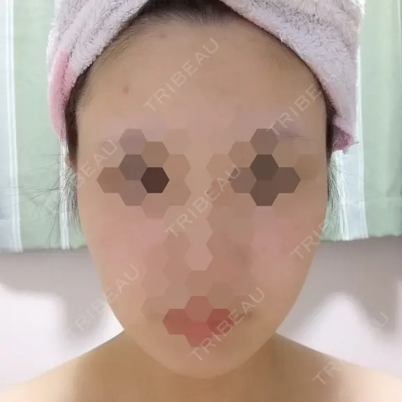 ボトックス（エラ・小顔） 湘南美容クリニック 静岡院 DAY 21 メイン用