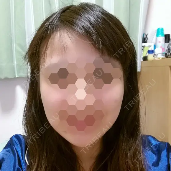 ボトックス（エラ・小顔） 湘南美容クリニック 静岡院 DAY 23 メイン用