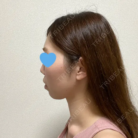 脂肪溶解注射（顔） 赤坂プレミアクリニック DAY 14 メイン用