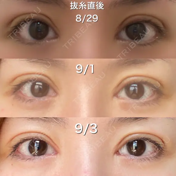 二重切開 / 眼瞼下垂（切開） / 目元修正 シエルクリニック DAY 10 メイン用