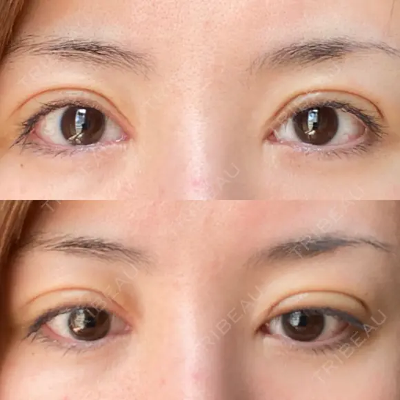 二重切開 / 眼瞼下垂（切開） / 目元修正 シエルクリニック DAY 10 メイン用