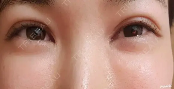 シワ取りボトックス 湘南美容クリニック 仙台院 DAY 49 メイン用