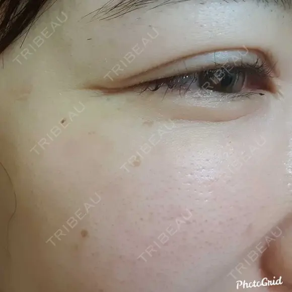 シワ取りボトックス 湘南美容クリニック 仙台院 DAY 49 メイン用