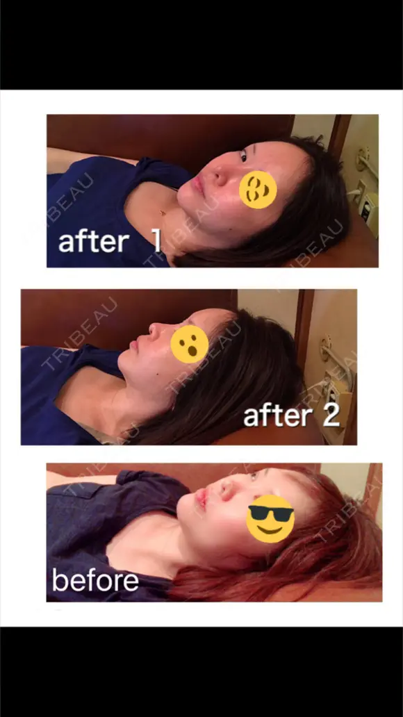 糸リフト / 骨切り（あご） / 骨削り（エラ） / 骨削り（頬） / 脂肪吸引（顔） / 輪郭修正 / 脂肪注入（額） / 脂肪注入（輪郭） / ハイフ（顔） GIRIN（ギリン）美容外科 DAY 341 メイン用