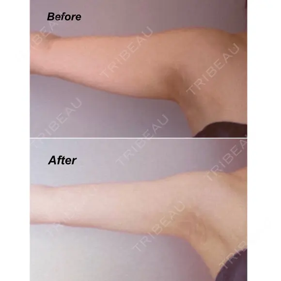 脂肪吸引（二の腕） Mods Clinic（モッズクリニック） 東京院 DAY 92 メイン用