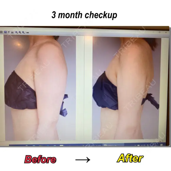 脂肪吸引（二の腕） Mods Clinic（モッズクリニック） 東京院 DAY 92 メイン用