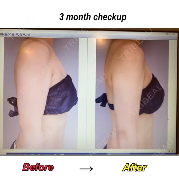 脂肪吸引（二の腕） Mods Clinic（モッズクリニック） 東京院 DAY 92 メイン用