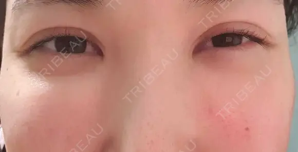 シワ取りボトックス 湘南美容クリニック 仙台院 DAY 51 メイン用