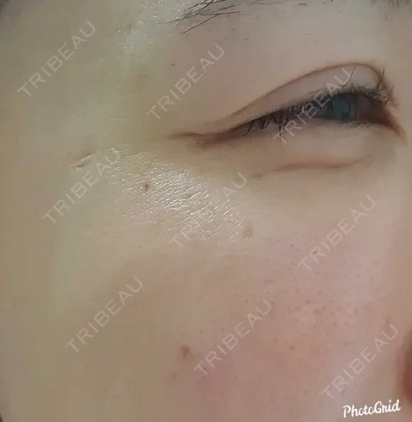 シワ取りボトックス 湘南美容クリニック 仙台院 DAY 51 メイン用