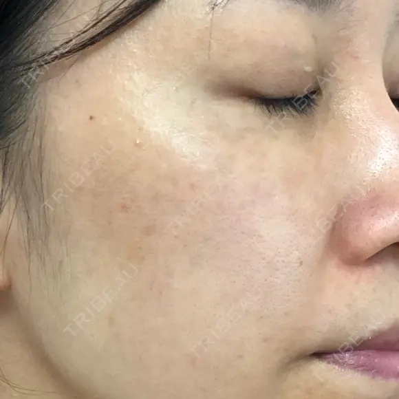 シミ取りレーザー / YAGレーザー 仁愛クリニック DAY 93 メイン用