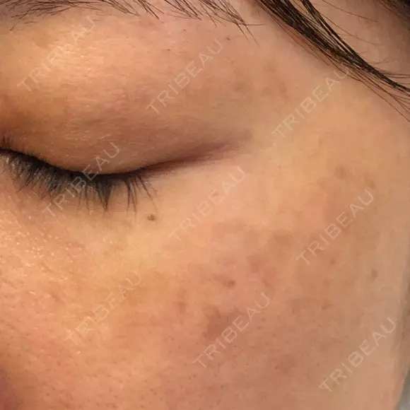 シミ取りレーザー / YAGレーザー 仁愛クリニック DAY 93 メイン用