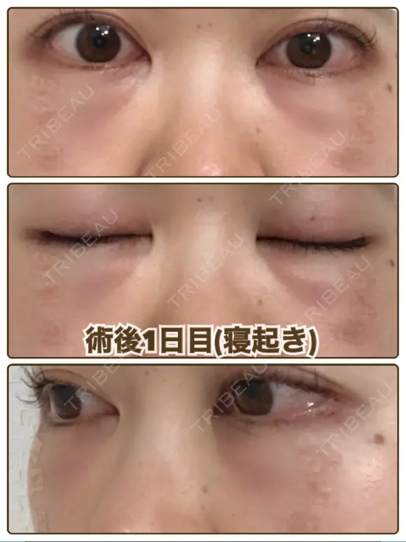 クマ治療 / 脂肪吸引（脚） / 下まぶたたるみ取り / 下まぶたの脂肪取り 湘南美容クリニック 千葉センシティ院 DAY 1 メイン用