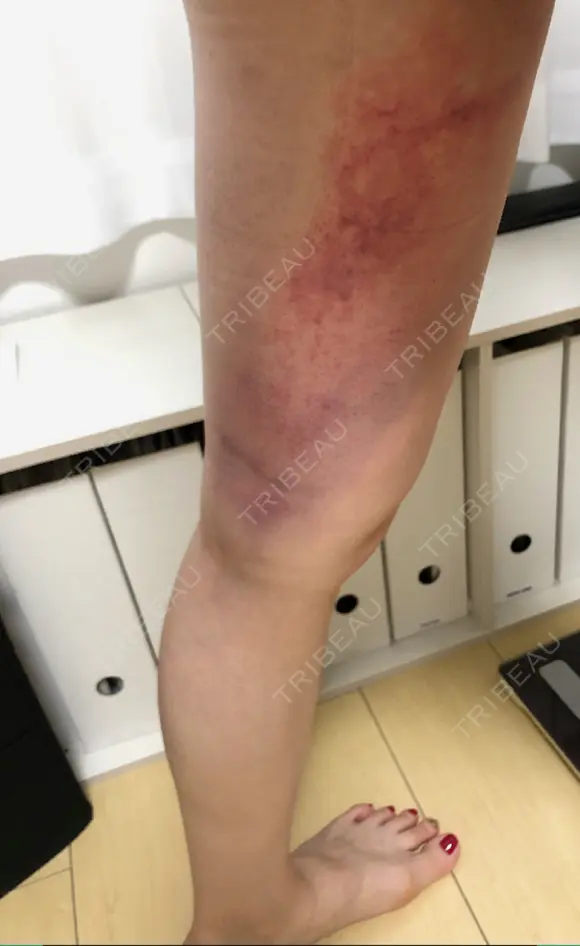クマ治療 / 脂肪吸引（脚） / 下まぶたたるみ取り / 下まぶたの脂肪取り 湘南美容クリニック 千葉センシティ院 DAY 2 メイン用
