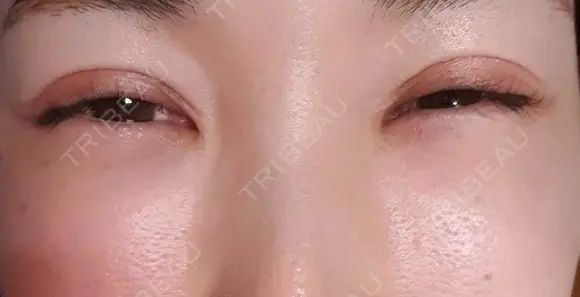 シワ取りボトックス 湘南美容クリニック 仙台院 DAY 52 メイン用