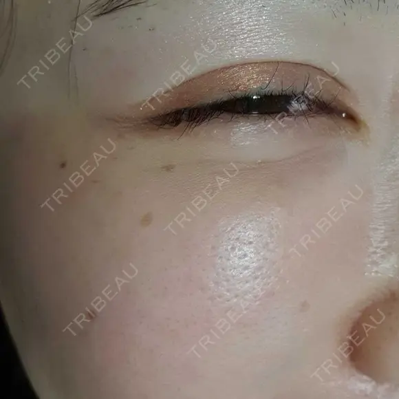 シワ取りボトックス 湘南美容クリニック 仙台院 DAY 52 メイン用