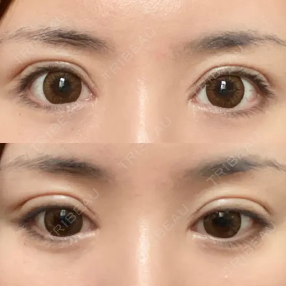 二重切開 / 眼瞼下垂（切開） / 目元修正 シエルクリニック DAY 15 メイン用