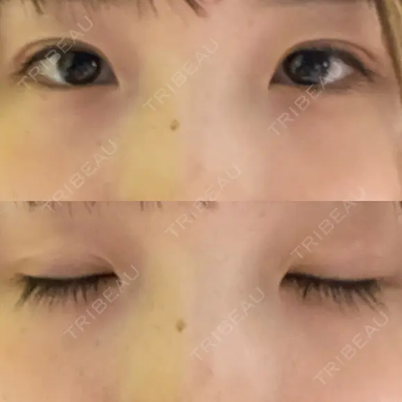 二重埋没 湘南美容クリニック 赤坂見附院 AFTER メイン用