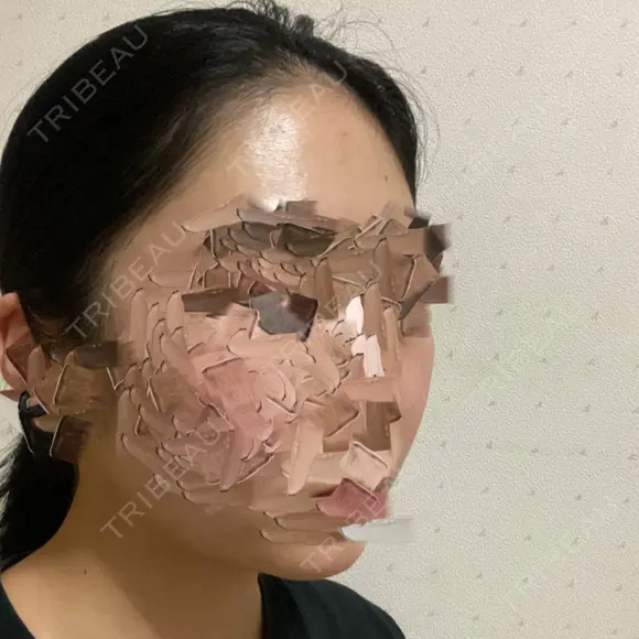 骨削り（頬） ボンディ美容整形外科（旧リオン整形外科） DAY 203 メイン用