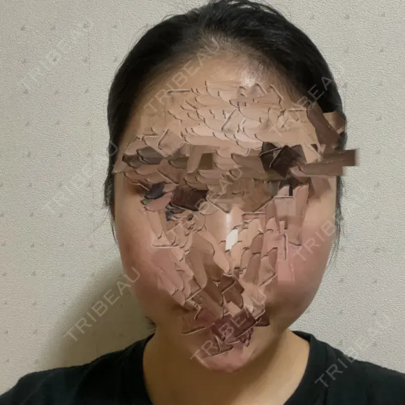 骨削り（頬） ボンディ美容整形外科（旧リオン整形外科） AFTER メイン用