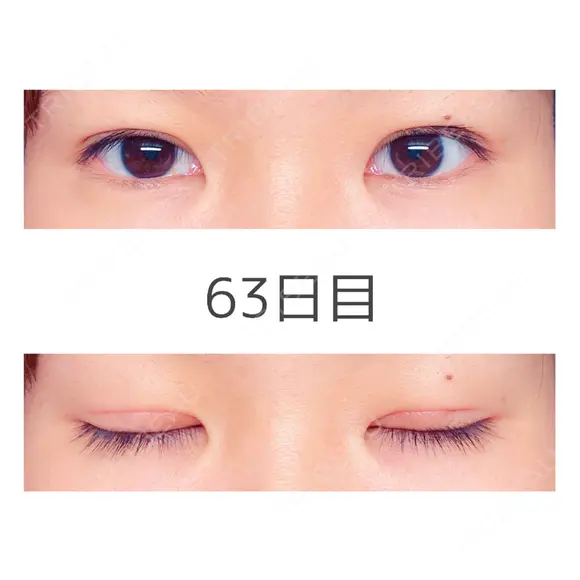 二重切開 TCB東京中央美容外科 宇都宮院 DAY 63 メイン用