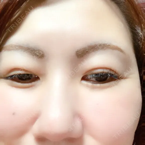 下まぶたの脂肪取り 湘南美容クリニック 千葉センシティ院 DAY 29 メイン用